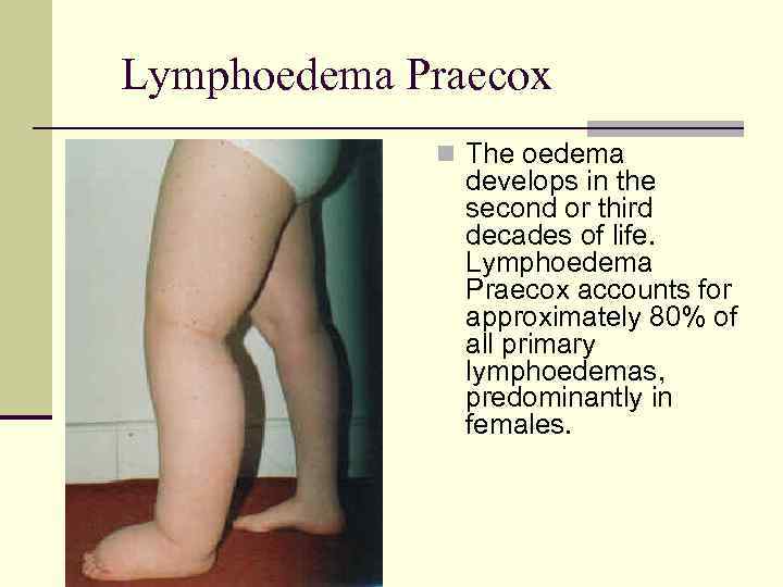 Lymphoedema Praecox n The oedema develops in the second or third decades of