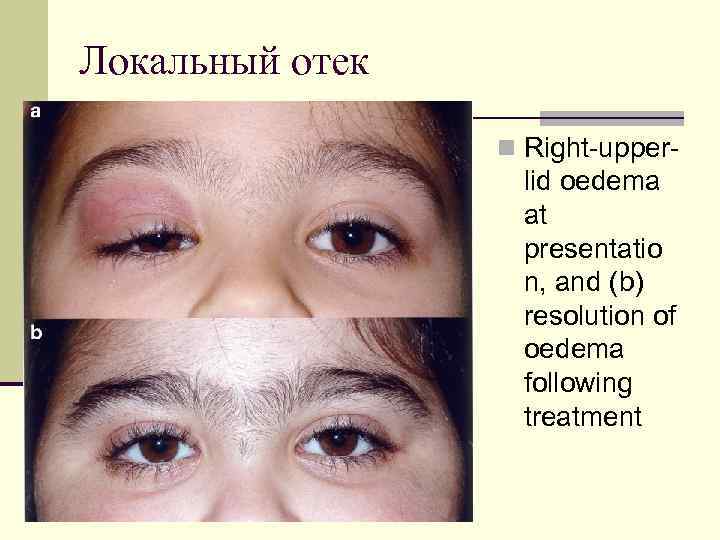 Локальный отек n Right-upper- lid oedema at presentatio n, and (b) resolution of oedema