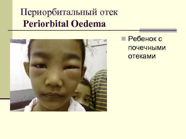Периорбитальный отек Periorbital Oedema n Ребенок с почечными отеками 