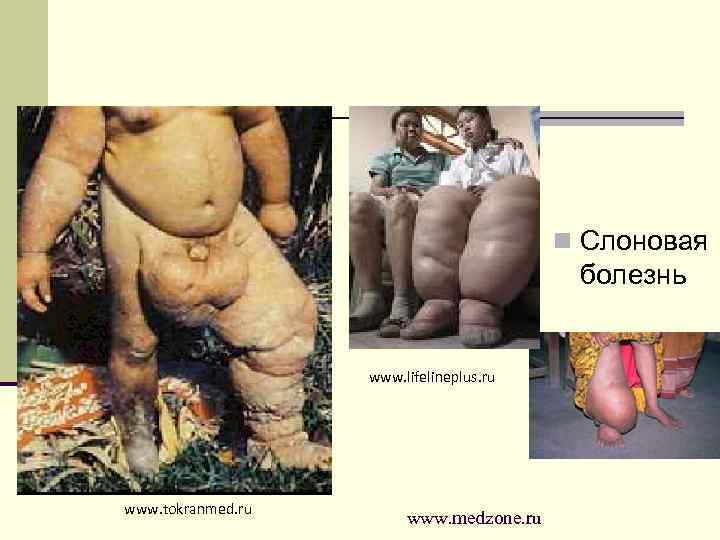 n Слоновая болезнь www. lifelineplus. ru www. tokranmed. ru www. medzone. ru 