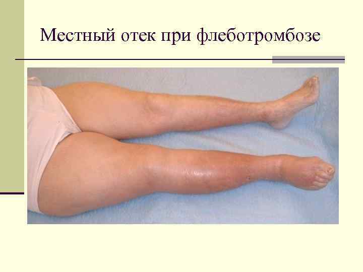 Местный отек при флеботромбозе 