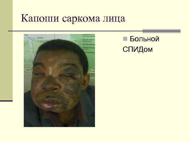 Капоши саркома лица n Больной СПИДом 