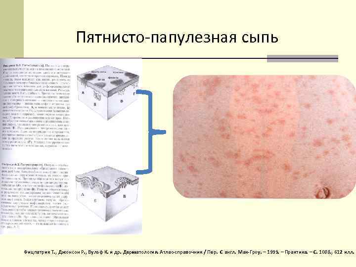 Пятнисто-папулезная сыпь Фицпатрик Т. , Джонсон Р. , Вульф К. и др. Дерматология. Атлас-справочник