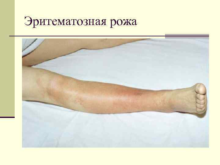 Эритематозная рожа 