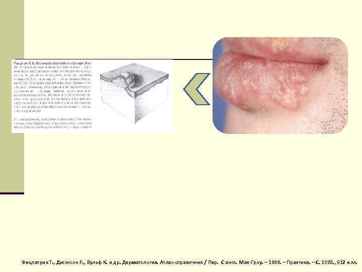 Фицпатрик Т. , Джонсон Р. , Вульф К. и др. Дерматология. Атлас-справочник / Пер.