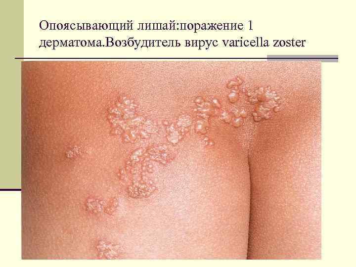 Опоясывающий лишай: поражение 1 дерматома. Возбудитель вирус varicella zoster 