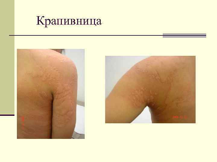 Крапивница 