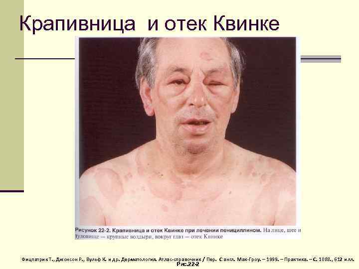 Крапивница и отек Квинке Фицпатрик Т. , Джонсон Р. , Вульф К. и др.