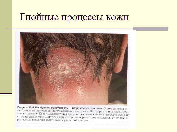 Гнойные процессы кожи 