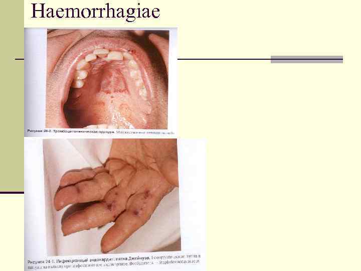 Haemorrhagiae 