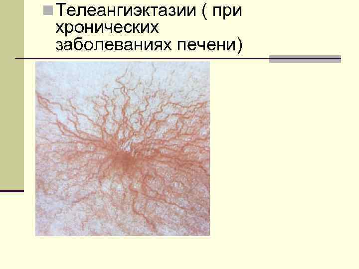 n Телеангиэктазии ( при хронических заболеваниях печени) 