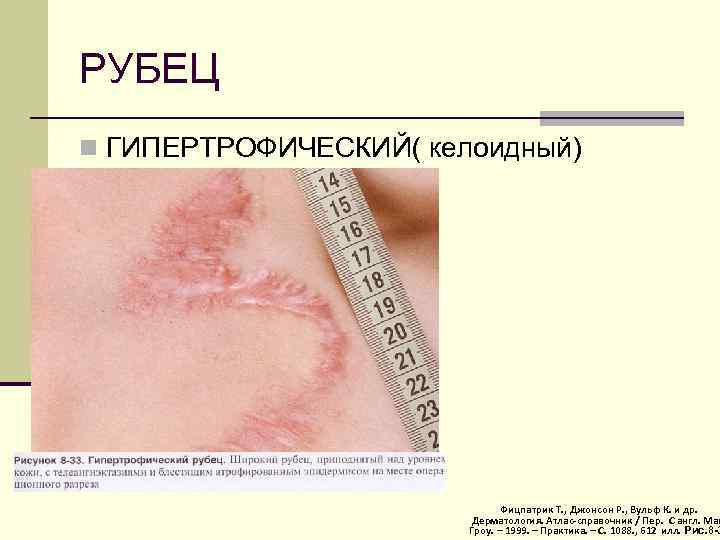 РУБЕЦ n ГИПЕРТРОФИЧЕСКИЙ( келоидный) Фицпатрик Т. , Джонсон Р. , Вульф К. и др.