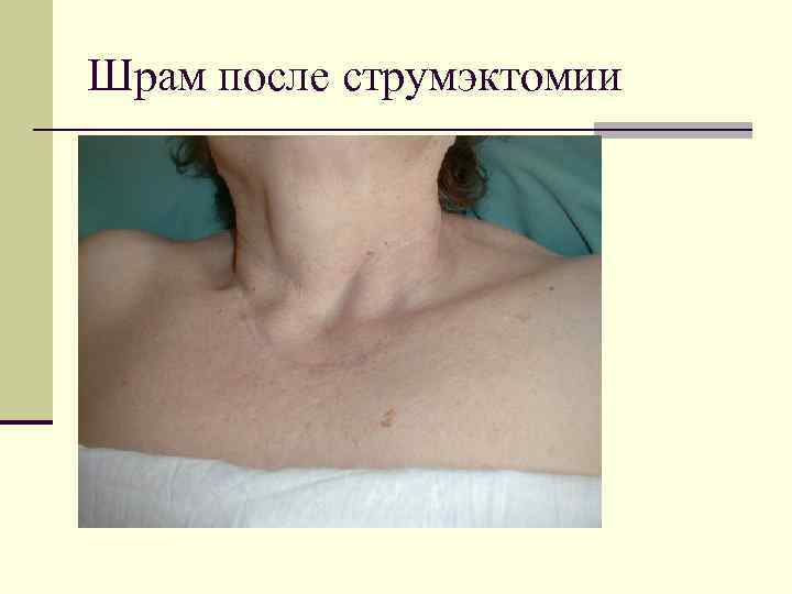 Шрам после струмэктомии 