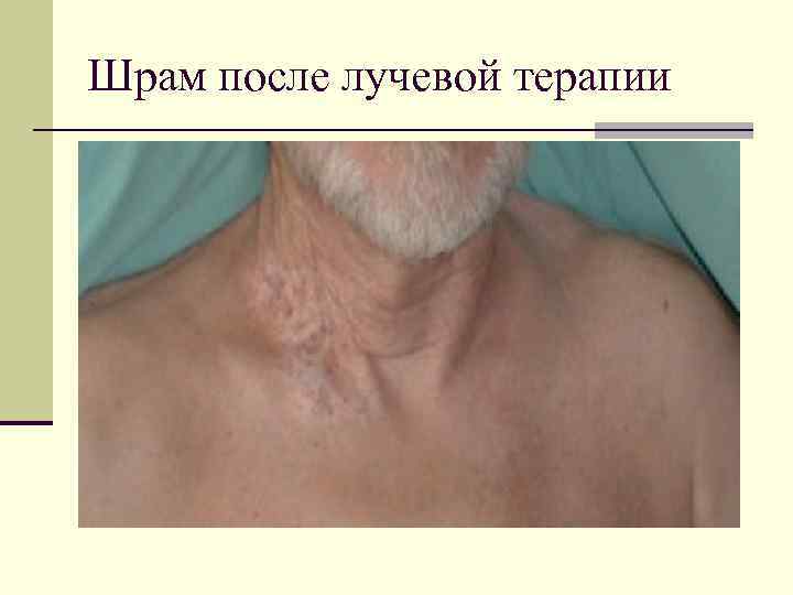 Шрам после лучевой терапии 