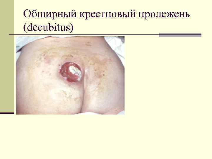 Обширный крестцовый пролежень (decubitus) 