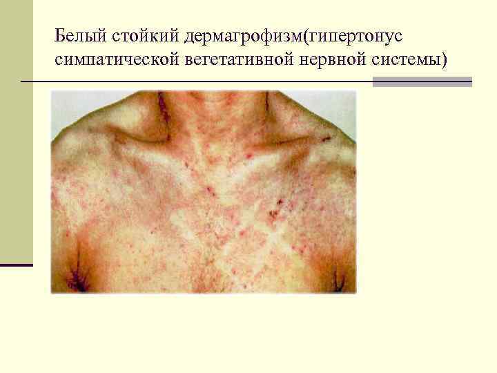 Белый стойкий дермагрофизм(гипертонус симпатической вегетативной нервной системы) 