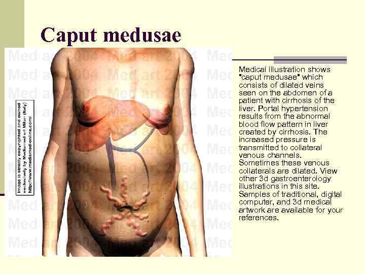 Caput medusae n Medical illustration shows "caput medusae" which consists of dilated veins seen