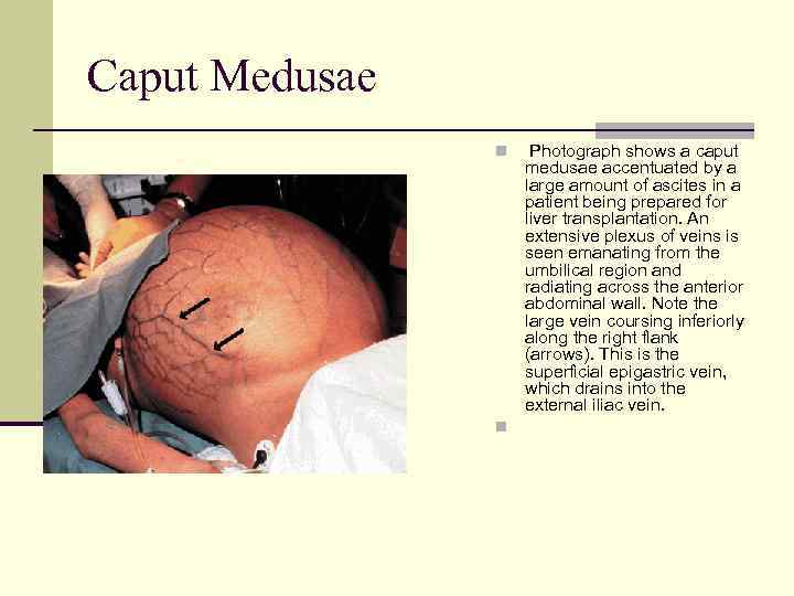 Caput Medusae n n Photograph shows a caput medusae accentuated by a large amount