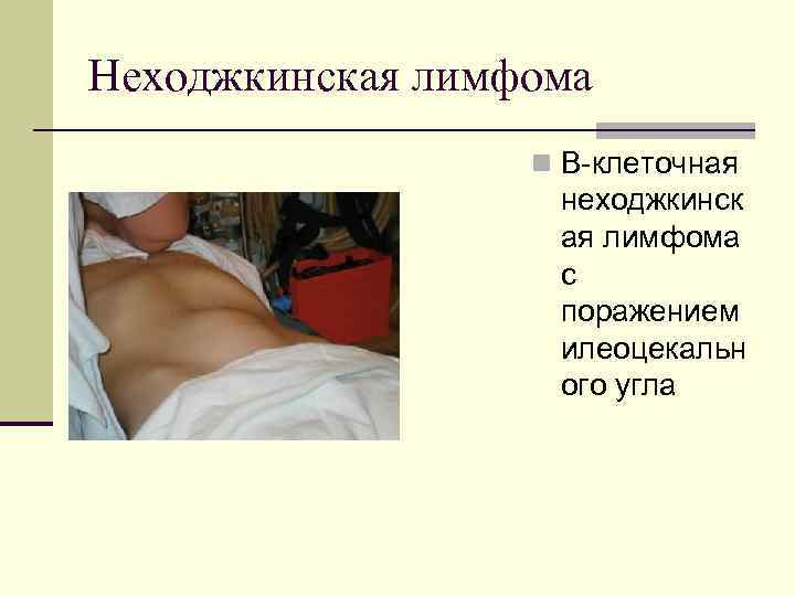 Неходжкинская лимфома n В-клеточная неходжкинск ая лимфома с поражением илеоцекальн ого угла 