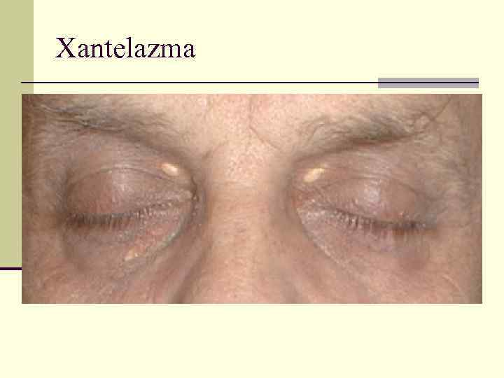Xantelazma 