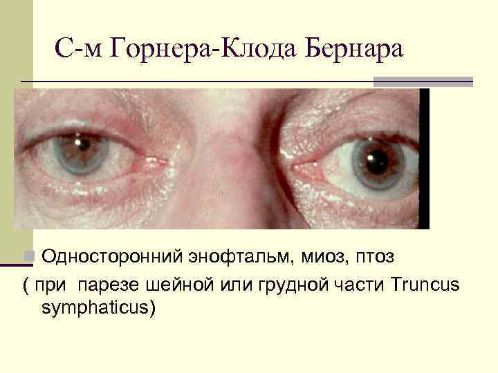 С-м Горнера-Клода Бернара n Односторонний энофтальм, миоз, птоз ( при парезе шейной или грудной