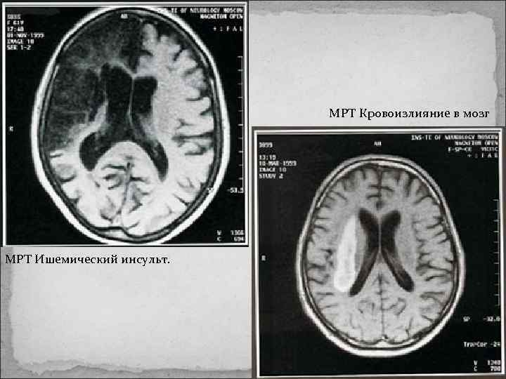 Мрт инсульт картинки