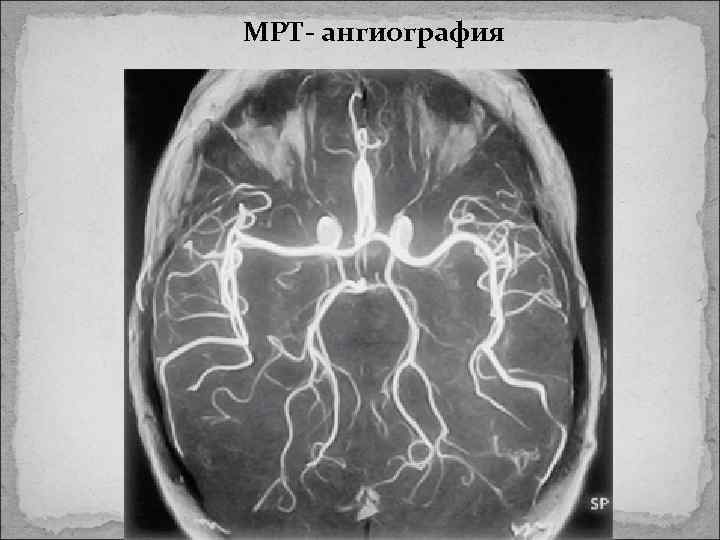 МРТ- ангиография 
