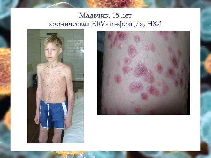 Мальчик, 15 лет хроническая EBV- инфекция, НХЛ 