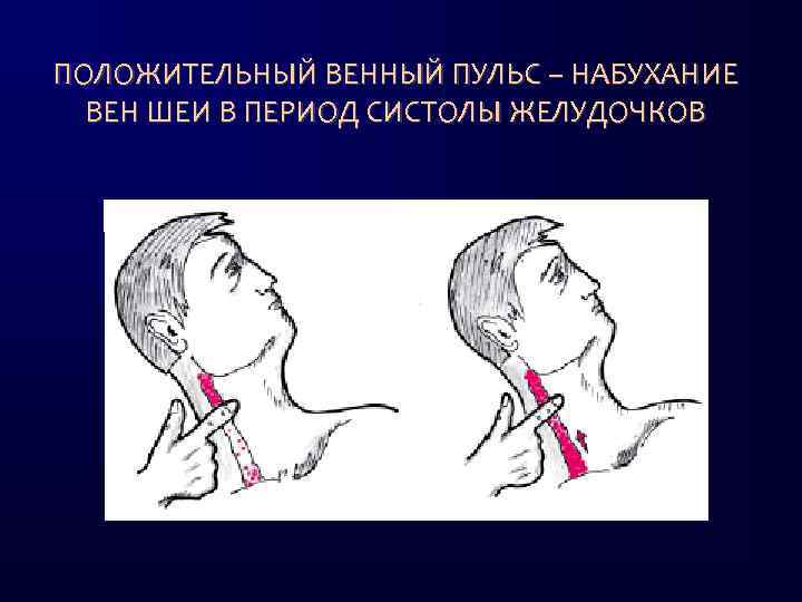 Отрыв хорды трикуспидального клапана