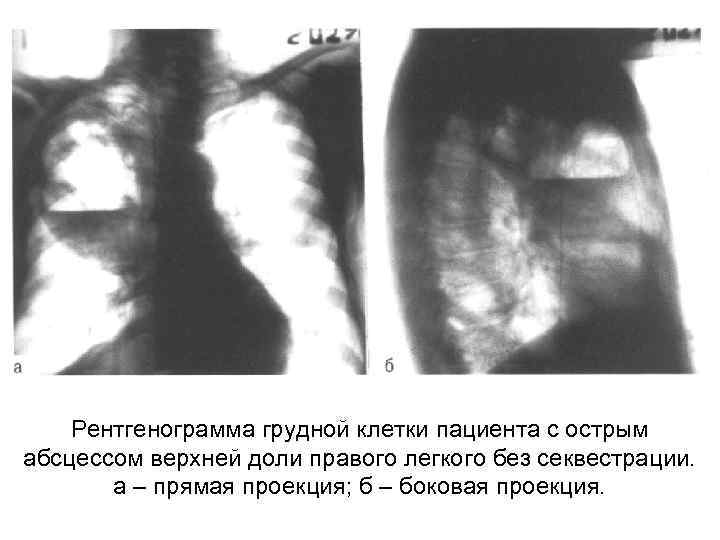 Рентгенограмма грудной клетки пациента с острым абсцессом верхней доли правого легкого без секвестрации. а