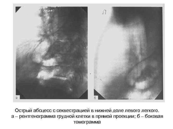 Острый абсцесс с секвестрацией в нижней доле левого легкого. а – рентгенограмма грудной клетки