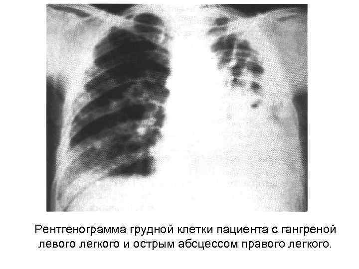 Рентгенограмма грудной клетки пациента с гангреной левого легкого и острым абсцессом правого легкого. 