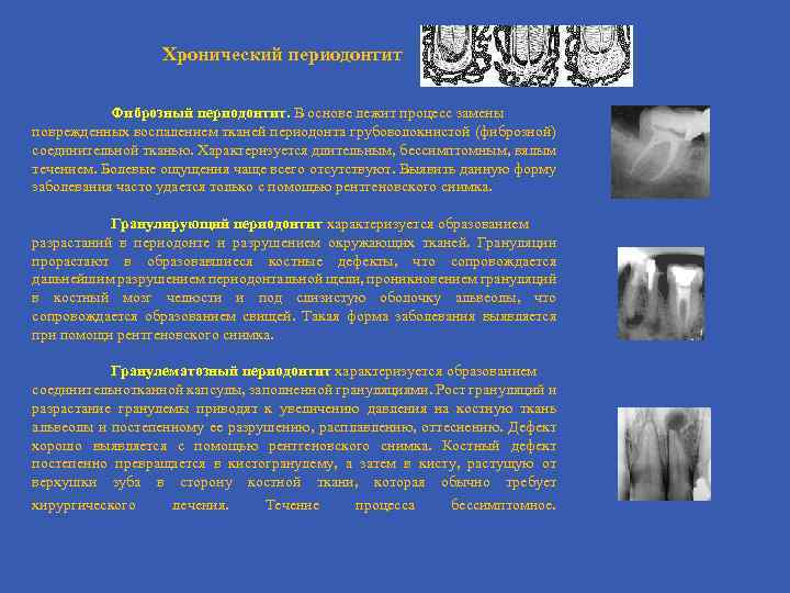 Хронический фиброзный периодонтит лечение. Хронический фиброзный периодонтит методичка. Фиброзный периодонтит рентгенограмма. Хронический фиброзный периодонтит рентген. Инфекционный периодонтит.