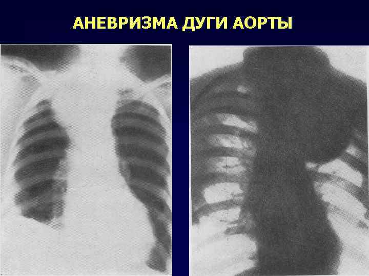 Аневризма грудной аорты фото