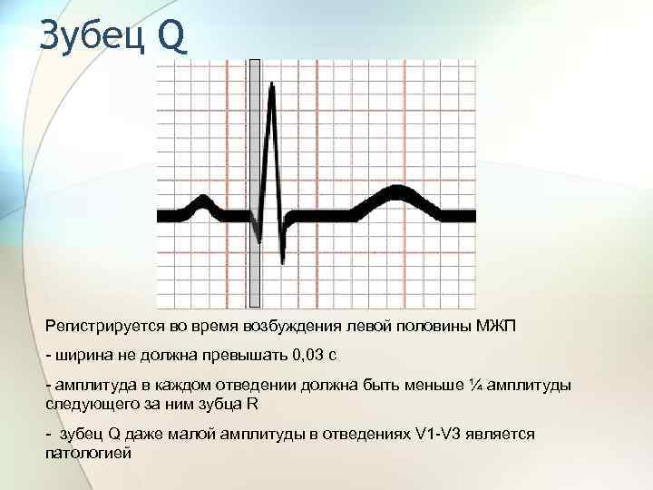 Зубец Q Регистрируется во время возбуждения левой половины МЖП - ширина не должна превышать