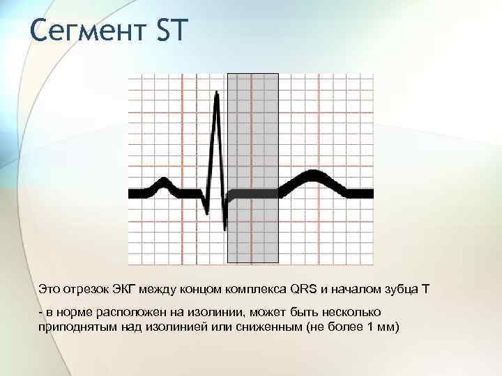 Сегмент ST Это отрезок ЭКГ между концом комплекса QRS и началом зубца Т -