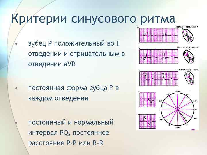 Критерии синусового ритма • зубец Р положительный во II отведении и отрицательным в отведении