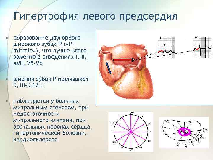 Увеличение предсердий лечение. Гипертрофия левого предсердия аускультация. Двугорбый зубец на ЭКГ. Электрическая ось сердца при гипертрофии левого предсердия.