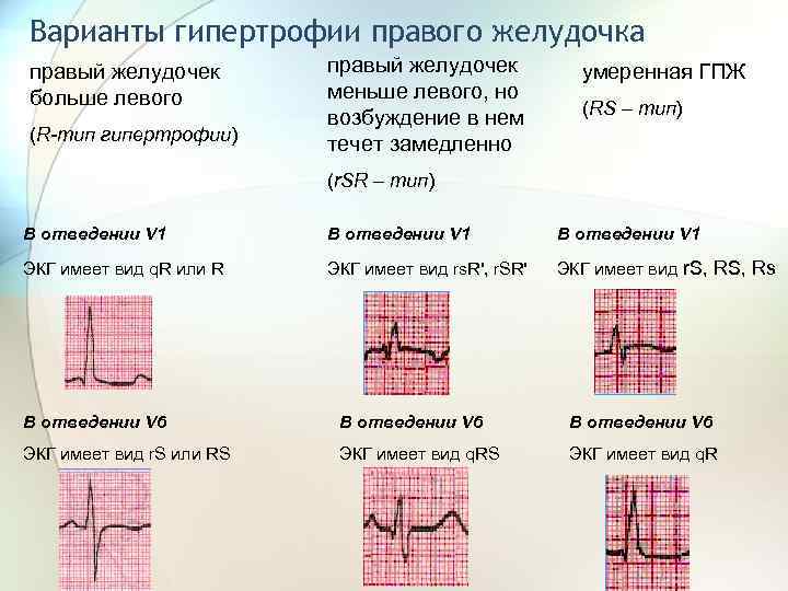 Гипертрофия правого желудочка