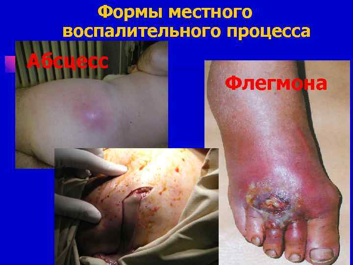 Формы местного воспалительного процесса Абсцесс Флегмона 