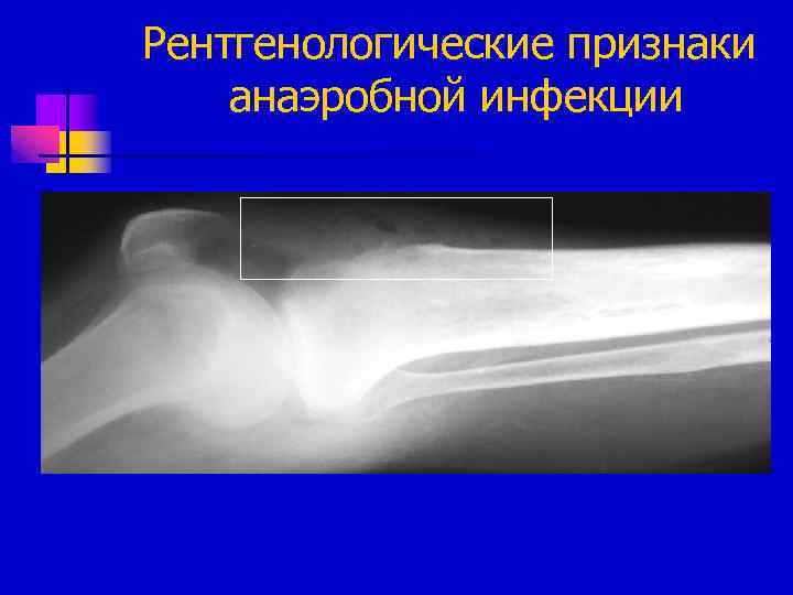Рентгенологические признаки анаэробной инфекции 