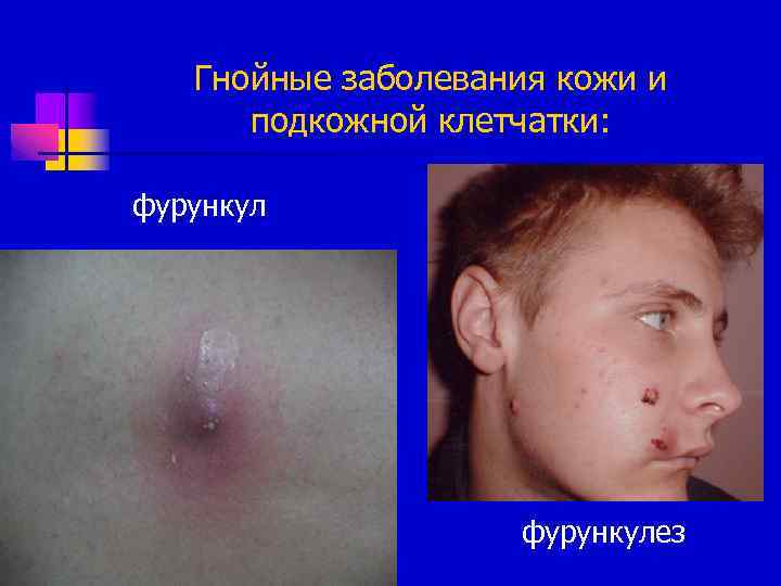 Гнойные заболевания кожи и подкожной клетчатки: фурункулез 