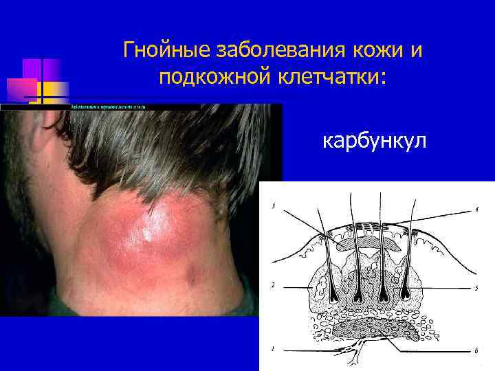 Гнойные заболевания кожи и подкожной клетчатки: карбункул 