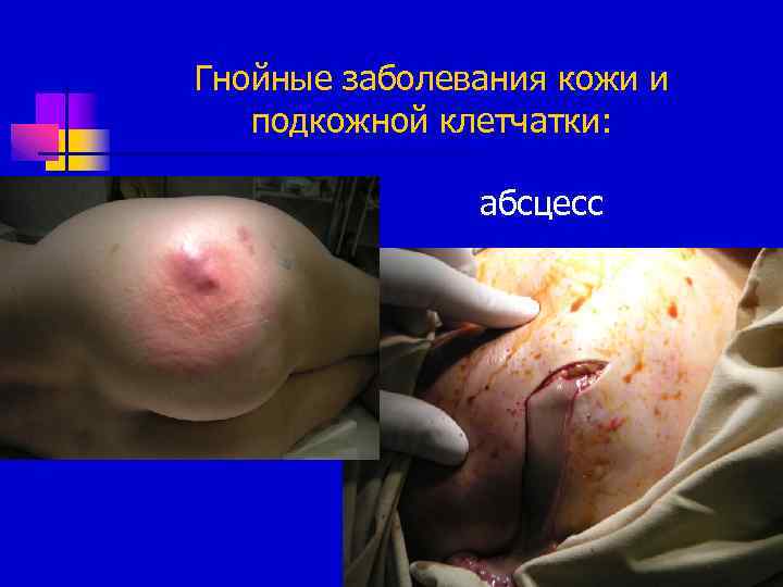 Гнойные заболевания кожи и подкожной клетчатки: абсцесс 