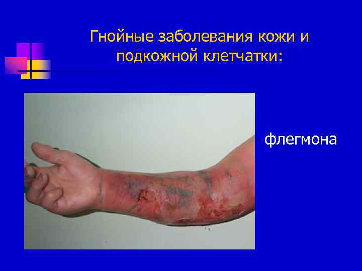 Гнойные заболевания кожи и подкожной клетчатки: флегмона 
