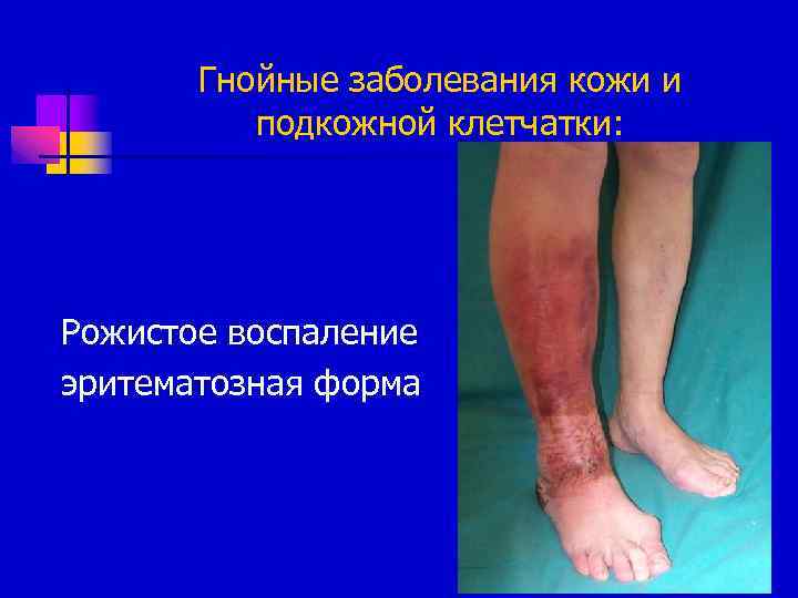 Гнойные заболевания кожи и подкожной клетчатки: Рожистое воспаление эритематозная форма 