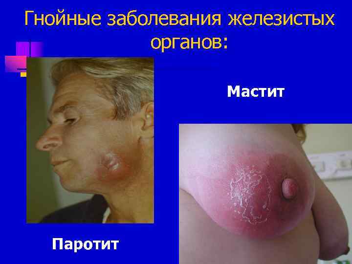 Гнойные заболевания железистых органов: Мастит Паротит 