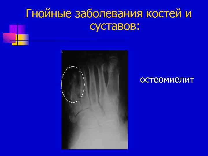 Гнойные заболевания костей и суставов: остеомиелит 