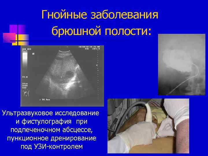 Гнойные заболевания брюшной полости: Ультразвуковое исследование и фистулография при подпеченочном абсцессе, пункционное дренирование под