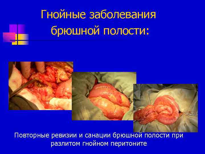 Гнойные заболевания брюшной полости: Повторные ревизии и санации брюшной полости при разлитом гнойном перитоните